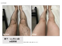 ヴィヴァーチェ(Vivace)/ひざ下脱毛　Before→after