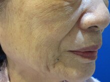 エステティックガーデン小町ストーリー/シミしわ毛穴改善【ビフォー】