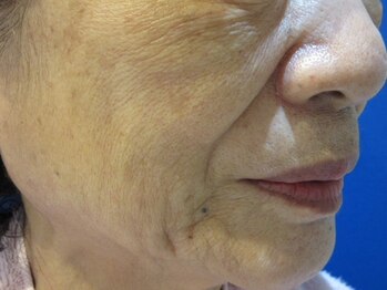 エステティックガーデン小町ストーリー/シミしわ毛穴改善【ビフォー】