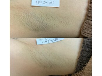 プリマ(Prima)/BEFORE&AFTER