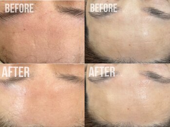 煌(kirameki)/【シワ】毛穴洗浄+micostella