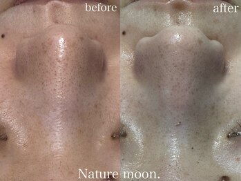 ナチュールムーン(Nature moon.)/毛穴洗浄