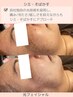 【シミ・くすみ改善】低刺激×即攻美肌◎次世代光フェイシャル