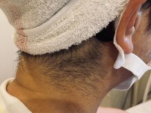 オアシスラグーン(OASIS LAGOON)/うなじ脱毛（症例１：before）