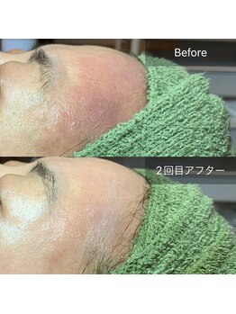 マリー(Mary.)/ハーブピーリング