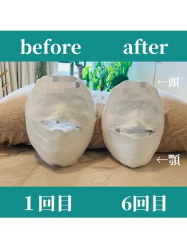 ロータス ビューティー(LOTUS Beauty)/石膏パック/ビフォーアフター