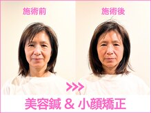 A1スポーツマッサージ治療院/【ビフォーアフター】美容鍼