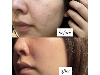 ブリリアントスマイル/皮膚ダメージ修復　40分13000円