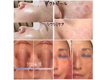 ナチュール(NaTuRu)の雰囲気（【ララピール】【ダクトピール】シミ・しわ・たるみ効果抜群★）