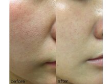 アイラッシュ ラピス(Lapis)/REVI陶肌トリートメント