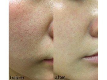 アイラッシュ ラピス(Lapis)/REVI陶肌トリートメント