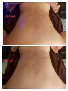 リリーミー(Lily me)/背中コルギのビフォーアフター