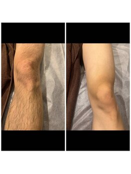 ファスモ(FASMO)/脚脱毛