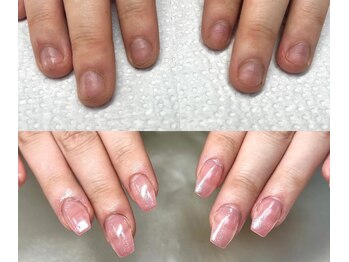 エムアンド(M and)/深爪矯正