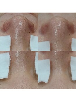 ボーソリューション(Beau-Solution)/【40代　開き毛穴/黒ずみ毛穴】