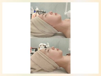 ソウナ(SONA)/剥離なし♪ハーブピーリング