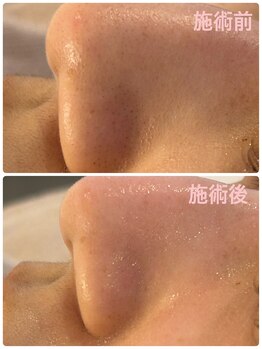 マナ(mana)/【黒ずみ解消】30分でツヤ肌へ