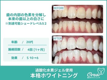 クレア(Crea)/【ホワイトニング症例写真】