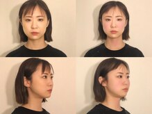 フラット(FURATTO)/Before - After【施術回数1回】