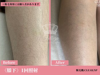 フェレザ 新潟(Felleza)/女性脱毛10