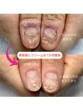 エムアンド(M and)/深爪矯正