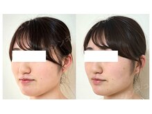 鍼灸院アゼ(AZE)/お顔の変化