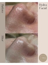 メイクス(Makes)/今話題の肌育毛穴洗浄♪