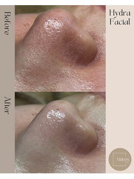 メイクス(Makes)/今話題の肌育毛穴洗浄♪