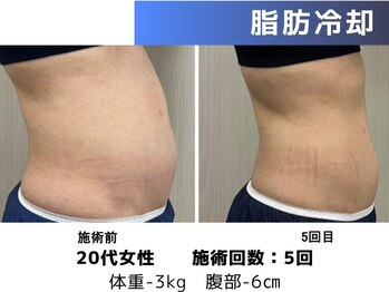 エープラス(A+)/脂肪冷却