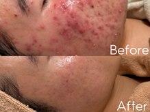 カレンジェビューティー(CarengeBeauty)/プラズマピュアプチ