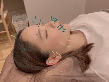 ソルム(solmu)の写真/美容鍼で気になる肌トラブル改善＆理想のハリ艶肌に☆痛みが少なく、鍼灸が初めての方にもおススメです♪