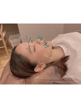 鍼灸施術を受けたい