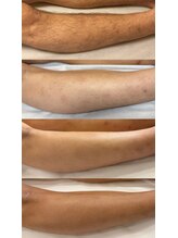 スキンラウンジ(SKIN LOUNGE)/圧倒的効果｜LED脱毛