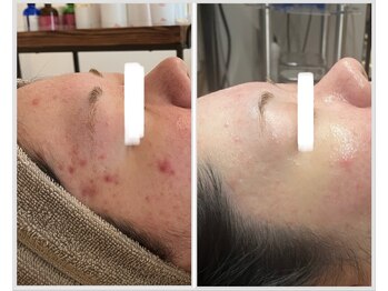 美しぐれ 溝の口店/【6ヶ月】プラズマ/ピーリング