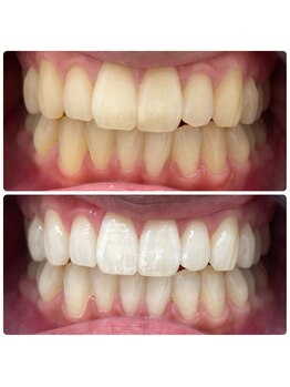 エクシアホワイトニング 日本橋店/人形町ホワイトニング