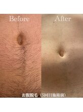 ミノア 熊本店(MINOA)/メンズ◆お腹脱毛