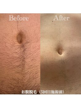 ミノア 熊本店(MINOA)/メンズ◆お腹脱毛