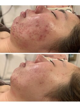 アンプリール(emplir)/トラブル肌 ニキビ肌・痕