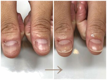 エムアンド(M and)/深爪矯正