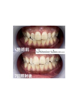 ホワイトニングサロン 京都烏丸店/ホワイトニング 施術例