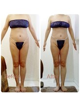 ピーエフ トウキョウ(PF TOKYO)/ハイパーナイフEX/全身身痩せ