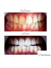 NAホワイトニング 自由が丘店/【before/after】
