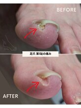 リットフット(LitFoot)/爪のトラブル