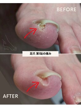 リットフット(LitFoot)/爪のトラブル