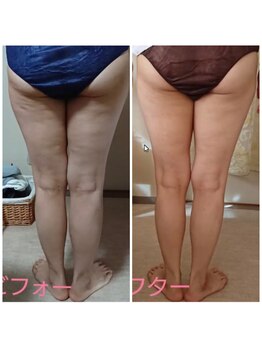 セルビューティー(Cell Beauty)/下半身20回、かなりの変化