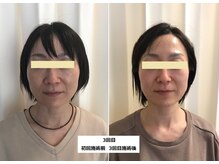 ナチュレアンドメディカ(Nature&Medica)/【たるみor小顔】ウルトラリフト