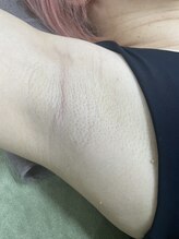 ナノハナ/鹿沼市の全身脱毛のナノハナ