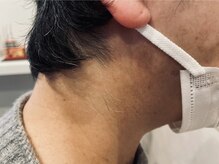 オアシスラグーン(OASIS LAGOON)/うなじ脱毛（症例１：after）