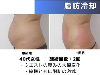 エープラス(A+)/脂肪冷却