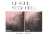 【頭皮集中】ヒト幹細胞培養上清液導入4ml 80分￥48000